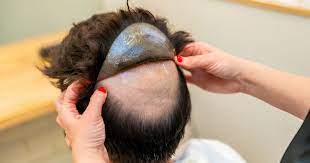 non surgical hair replacement